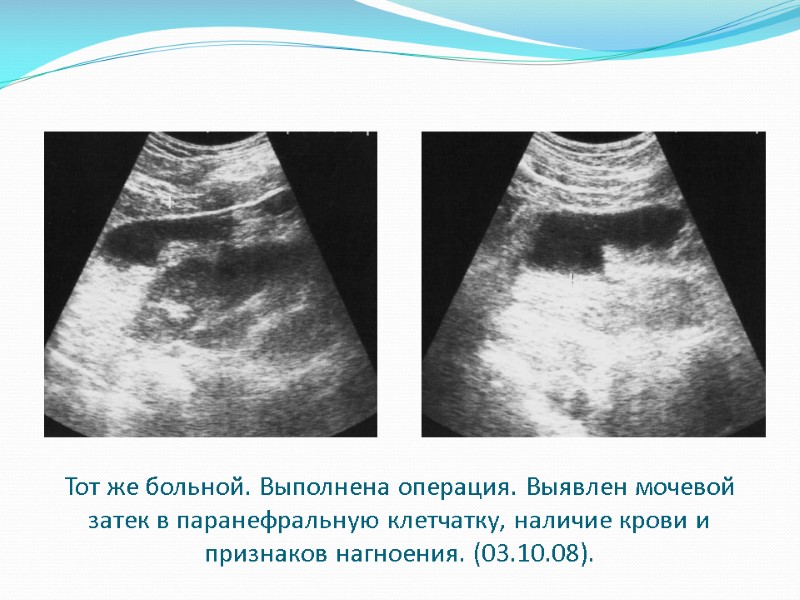 Тот же больной. Выполнена операция. Выявлен мочевой затек в паранефральную клетчатку, наличие крови и